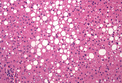 JNK and metabolic JNK and metabolic