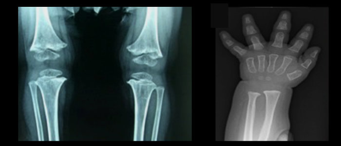  X-ray images showing a child's knee joint on the left and a child's hand on the right.