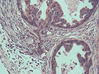 Invading Cancer Cells Invading Cancer Cells