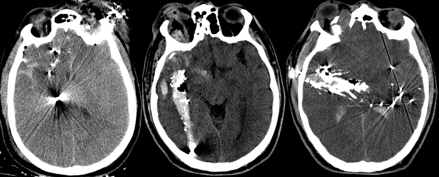 Penetrating trauma strip Penetrating trauma strip
