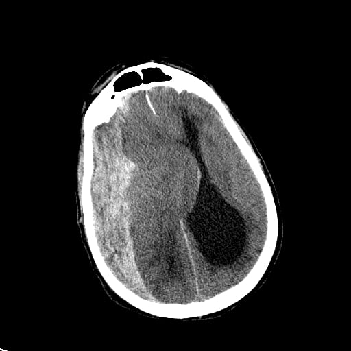 SDH with massive MLS SDH with massive MLS