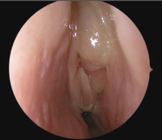 Image of inside the nose viewed with help of a inserted camera