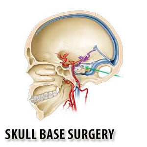 Skull base surgery