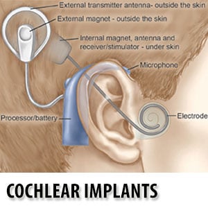 Cochlear implants