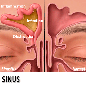 Sinus