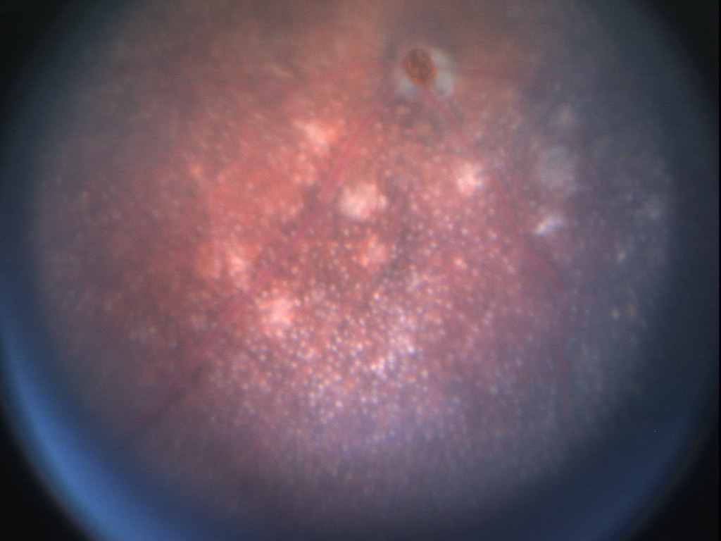 Dr. Punzo Recipient of Macular Degeneration BrightFocus Award