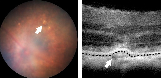 HK2-Mediated Aerobic Glycolysis in AMD
