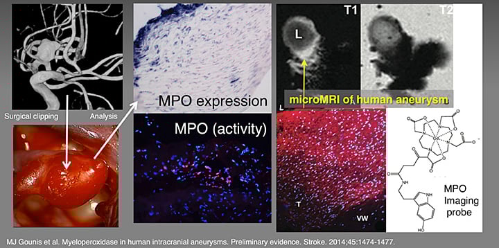 Human Brain Aneurysm Rupture Risk Assessment Using Non-invasive Imaging Human Brain Aneurysm Rupture Risk Assessment Using Non-invasive Imaging