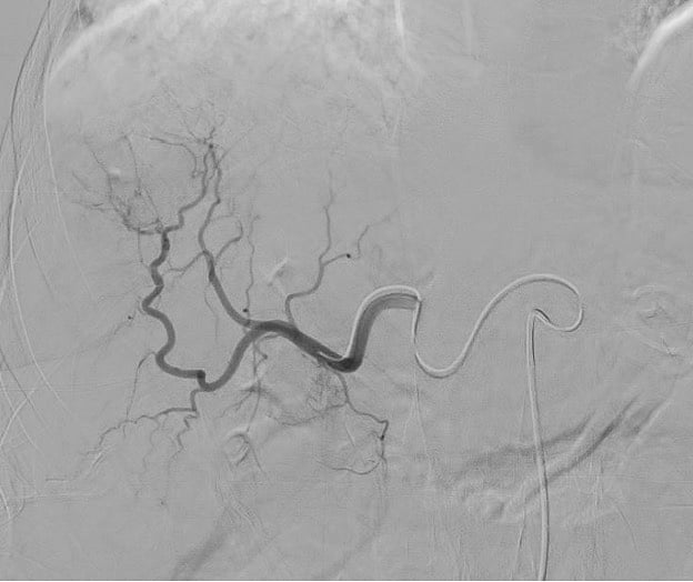  Angiogram-liver.jpg