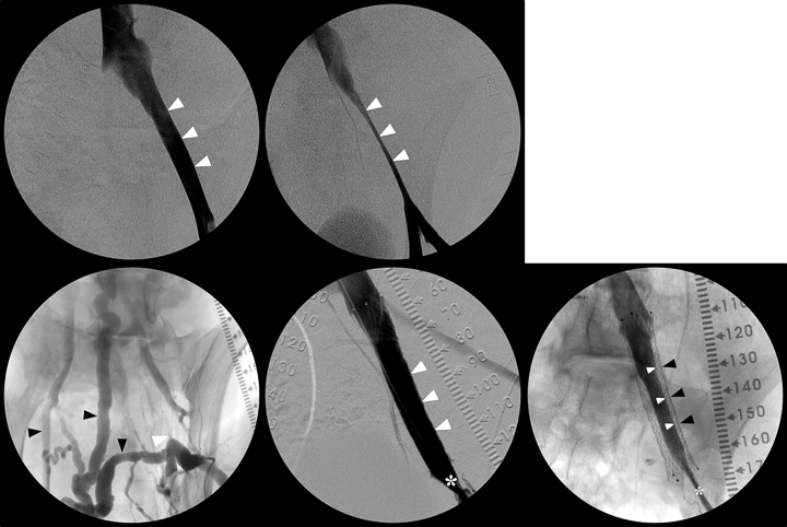 Large animal model of venous stenosis and thrombosis.