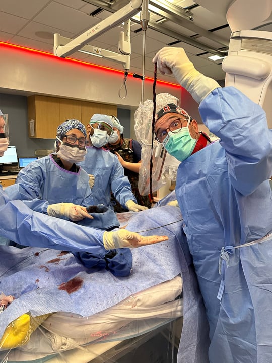 Human clot sample from a mechanical thrombectomy procedure, highlighting our Interventional Radiology team